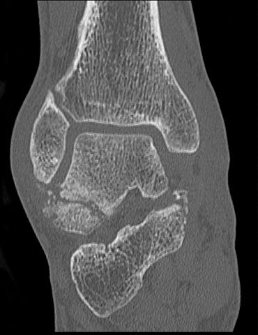 artrita nu îndoaie degetele ce boli doare articulația șoldului