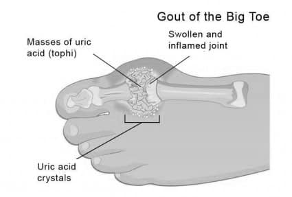 gori bol u zglob joint