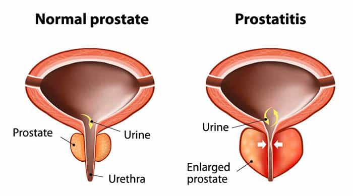 prostatitis vietnam