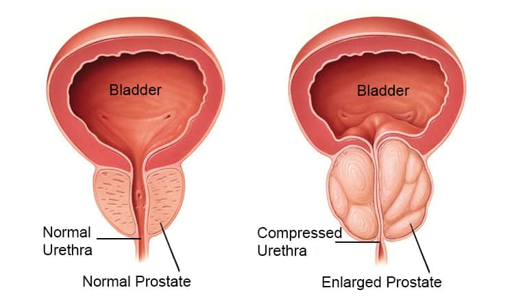 Vondt Prostata | diagnose, symptomer og
